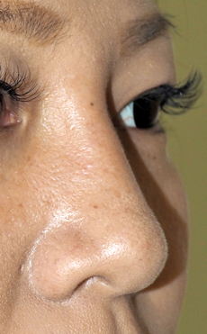 症例2　鼻ヒアルロン酸（隆鼻） 施術後