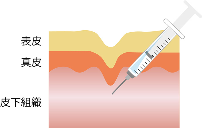 ヒアルロン酸注射とは ヒアルロン酸の皮下脂肪層への注入