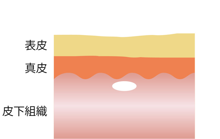 ヒアルロン酸注射とは ヒアルロン酸の皮下脂肪層への注入
