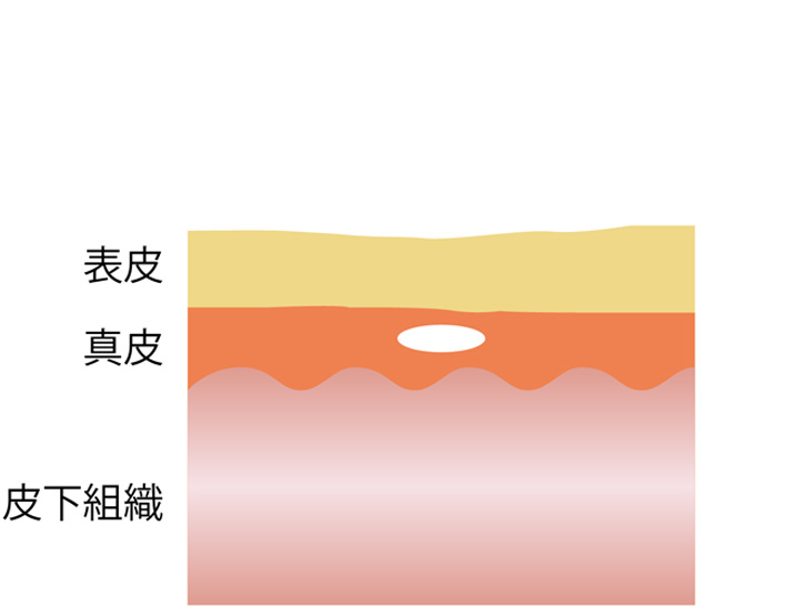 ヒアルロン酸注射とは ヒアルロン酸の皮下への注入