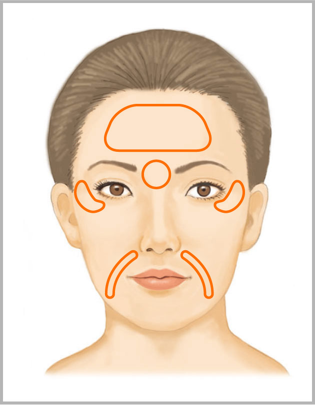 しわ・法令線ヒアルロン酸