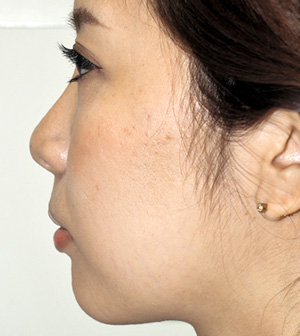 症例2　ヒアルロン酸（鼻・あご） 施術前