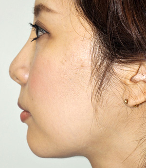 症例2　ヒアルロン酸（鼻・あご） 施術後