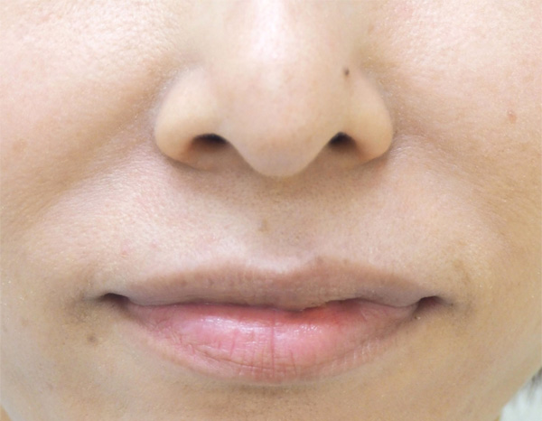 症例1　鼻翼基部ヒアルロン酸注射（貴族注射） 施術前