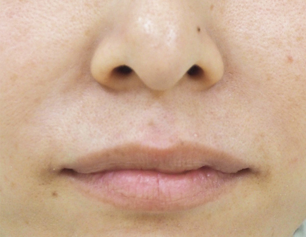 症例1　鼻翼基部ヒアルロン酸注射（貴族注射） 施術後