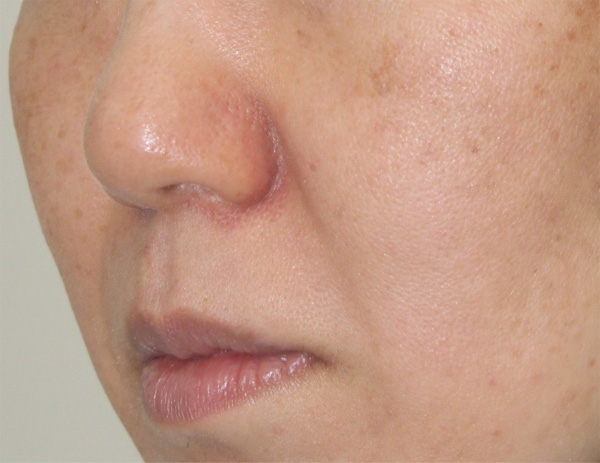 症例2　鼻翼基部ヒアルロン酸注射（貴族注射） 施術前