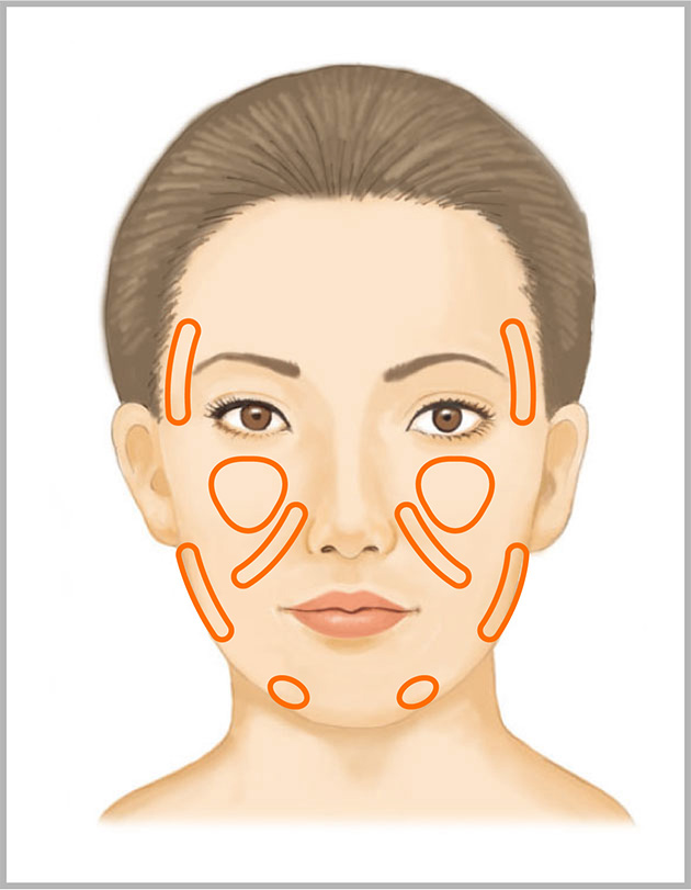 ヒアルロン酸リフト
