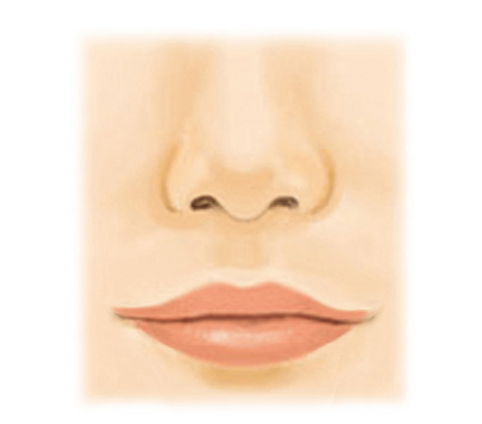 口角挙上（スマイルリップ）After