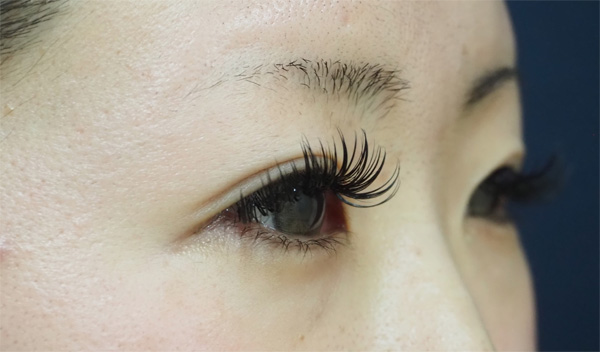 症例1　涙袋ヒアルロン酸 治療前