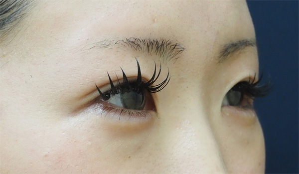 症例1　涙袋ヒアルロン酸 治療後