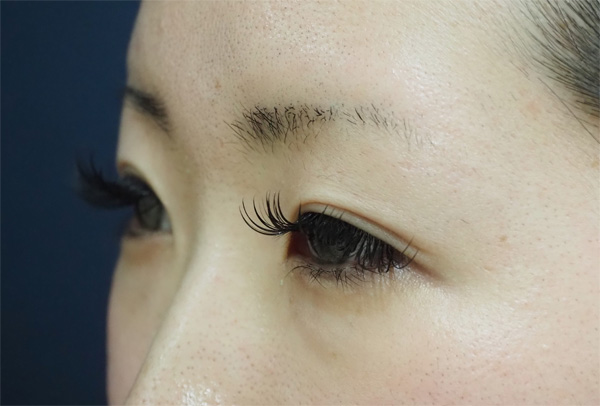 症例1　涙袋ヒアルロン酸 治療前