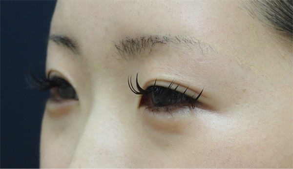 症例1　涙袋ヒアルロン酸 治療後