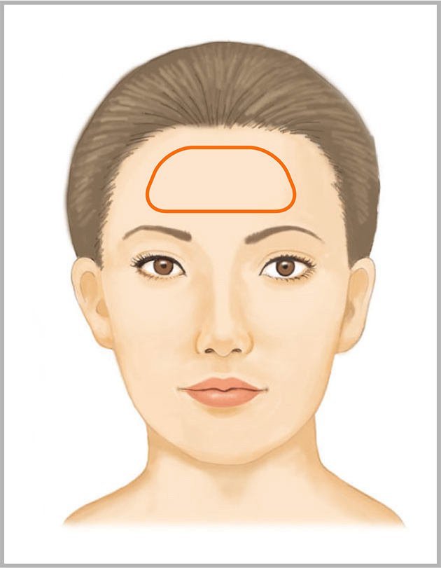 おでこのしわへのヒアルロン酸注射