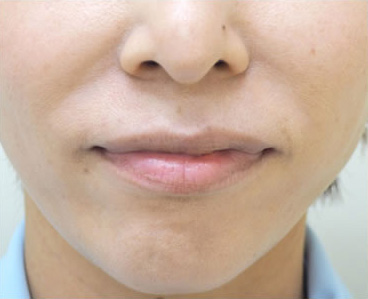 症例1　しわヒアルロン酸注射（法令線） 施術前