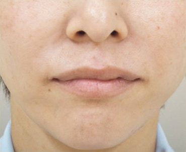 症例1　しわヒアルロン酸注射（法令線） 施術後