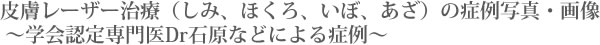 皮膚レーザー治療(しみ、ほくろ、いぼ、あざ)の症例写真・画像 〜学会認定専門医Dr石原による症例〜