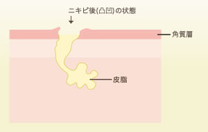 ニキビができるしくみ5