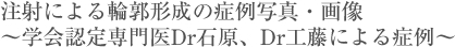 注射による輪郭形成の症例写真・画像 〜学会認定専門医Dr石原、Dr工藤による症例〜