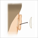 耳介軟骨移植による隆鼻術1