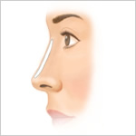 耳介軟骨移植による隆鼻術2
