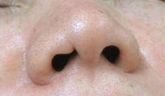 症例2　鼻孔縁の傷跡修正 手術前