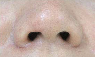 症例2　鼻孔縁の傷跡修正 手術後