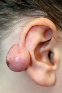 症例3　耳ケロイド切除術 手術前