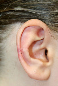 症例3　耳ケロイド切除術 手術後