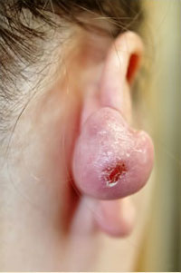 症例3　耳ケロイド切除術 手術前