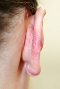 症例3　耳ケロイド切除術 手術後
