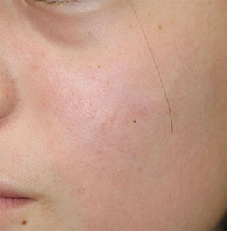 症例4　左頬傷跡修正 手術後