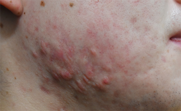 症例8　ニキビ跡ケロイド・ケナコルト注射 手術前