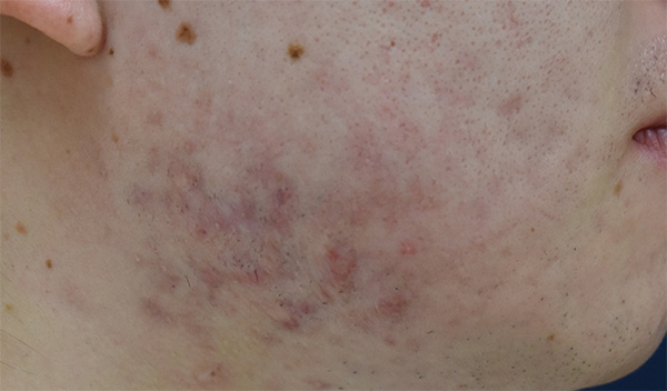 症例8　ニキビ跡ケロイド・ケナコルト注射 手術後