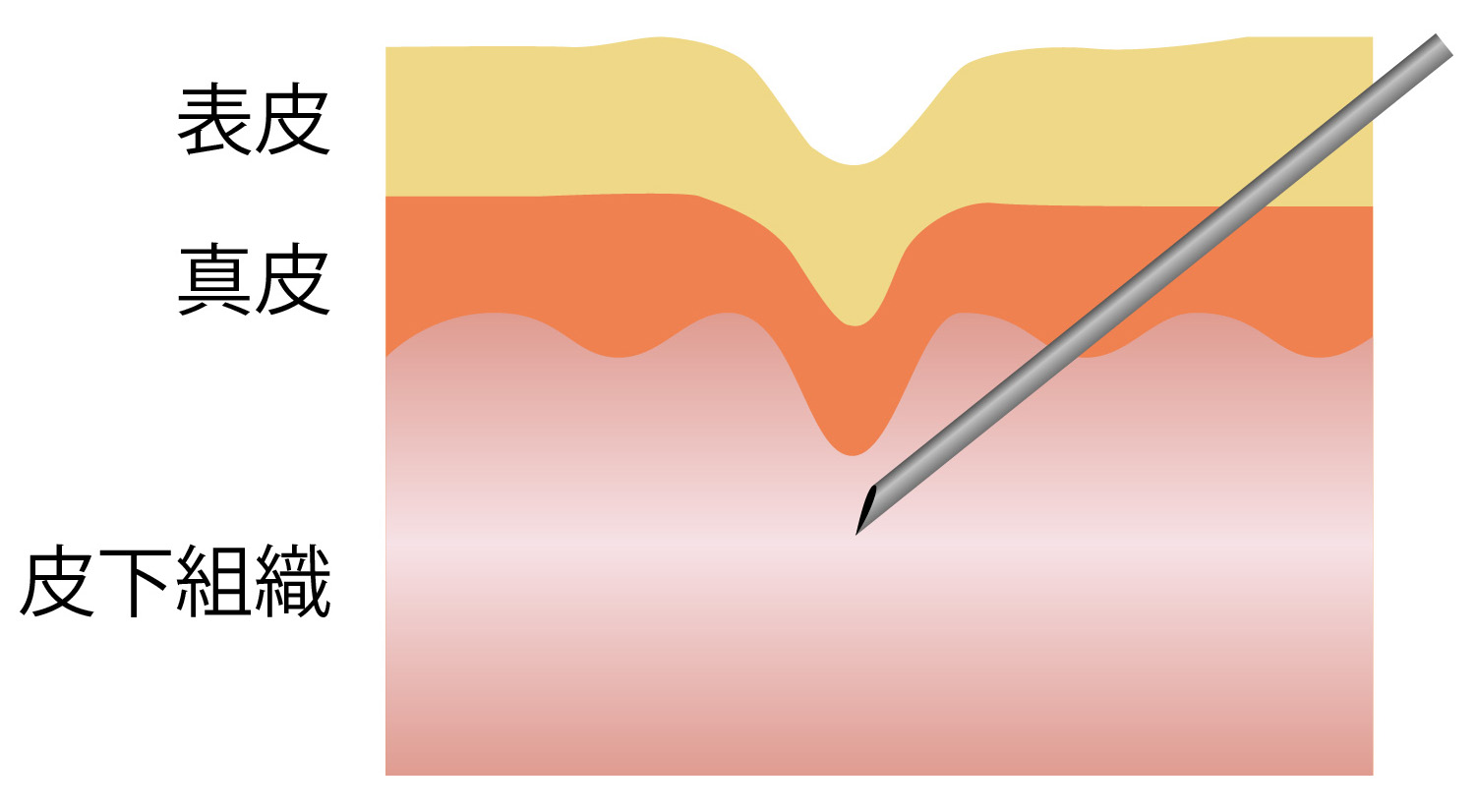 サブシジョン治療 Before