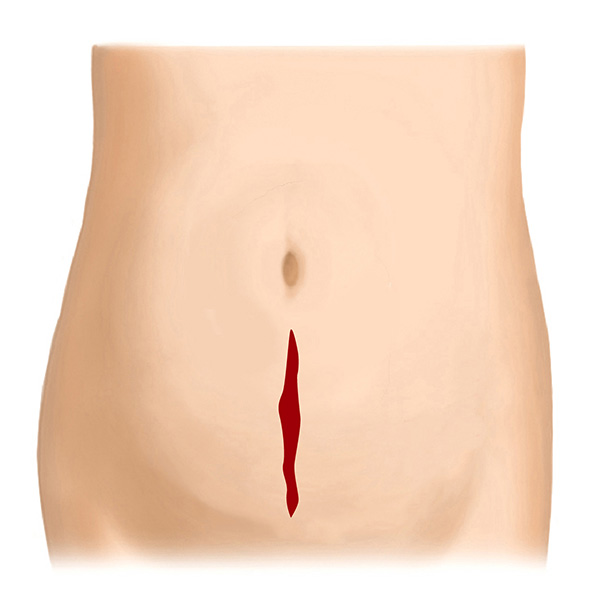 縦切開（縦の傷）