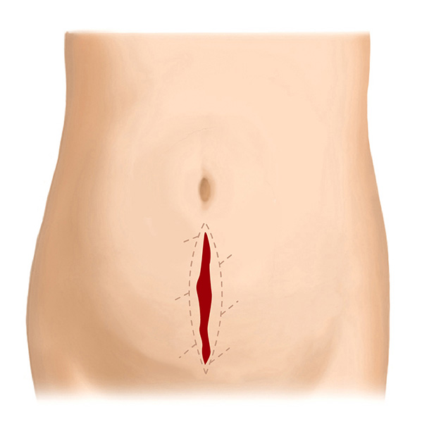 帝王切開後の傷跡（縦）～W形成術の応用～ Before