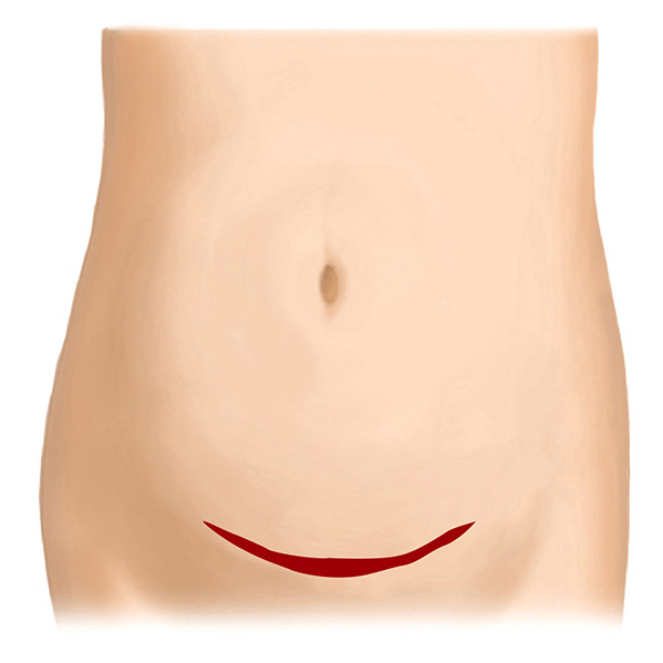 横切開（横の傷）