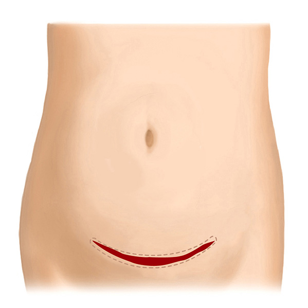 帝王切開後の傷跡修正（横） Before