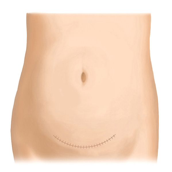帝王切開後の傷跡修正（横） After