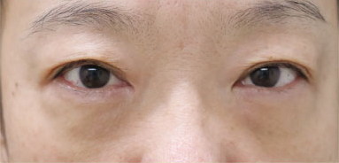 症例7　クマ取り（結膜側脱脂術） 手術後