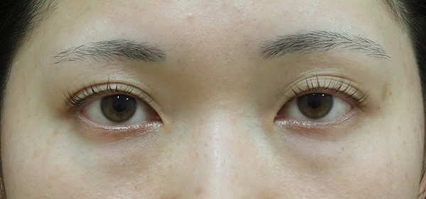 症例10　クマ取り（結膜側脱脂術） 手術前