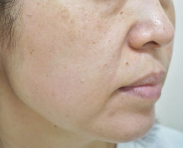 症例2　レーザートーニング（頬の肝斑、しみ、こじわ） 治療後