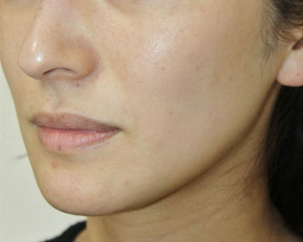 症例3　レーザートーニング（頬のしみ、毛穴） 治療後