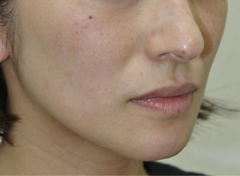 症例3　レーザートーニング（頬のしみ、毛穴） 治療前