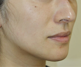 症例3　レーザートーニング（頬のしみ、毛穴） 治療後