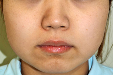 症例5　レーザートーニング（頬全体のくすみ、毛穴の開き） 治療後