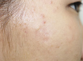 症例15　黒あざ（色素性母斑）切縫法 治療後
