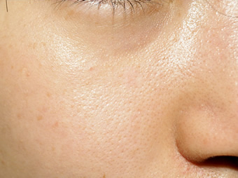 症例10　老人性色素斑（右頬のしみ）レーザー治療 治療後