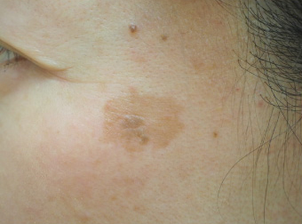 症例11　老人性色素斑＋脂漏性角化症（左頬のしみ）レーザー治療 治療前