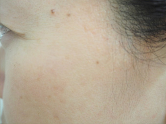 症例11　老人性色素斑＋脂漏性角化症（左頬のしみ）レーザー治療 治療後